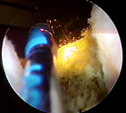 Greenlightlaser